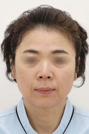 Note整形外科眉提升面部提升术前