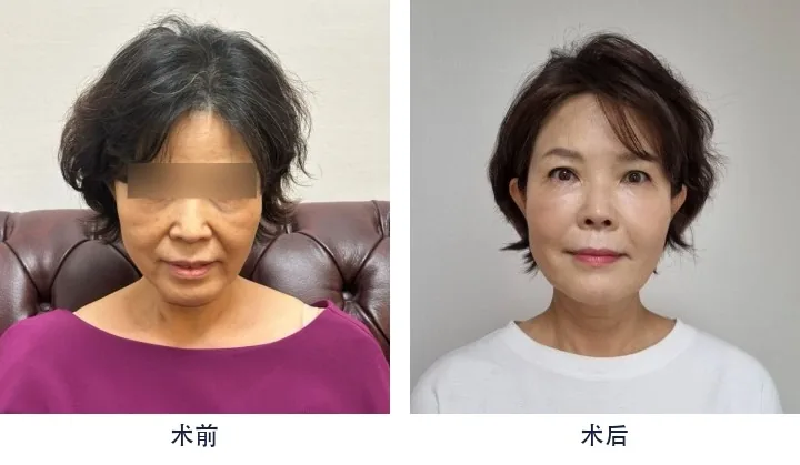Official before-and-after cases 5
