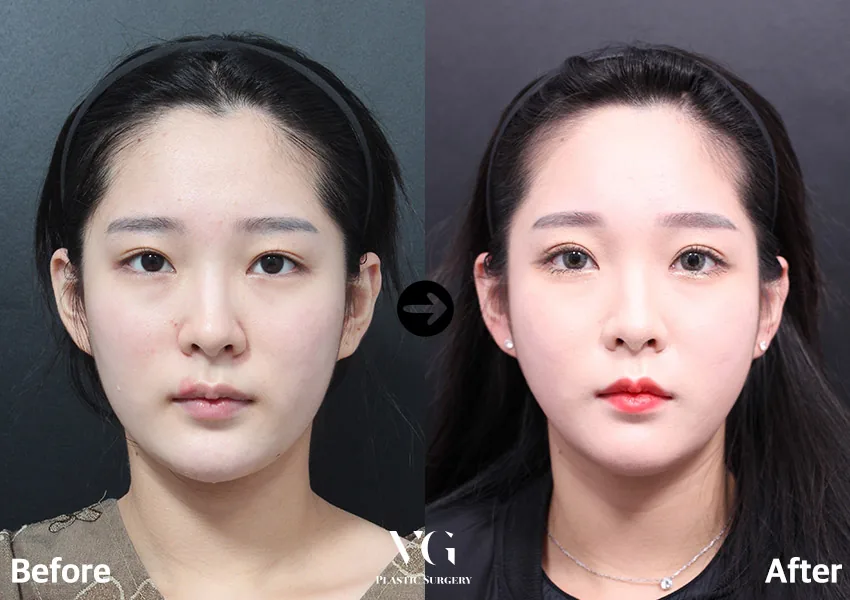Very Good Plastic Surgery Before-and-after cases 21