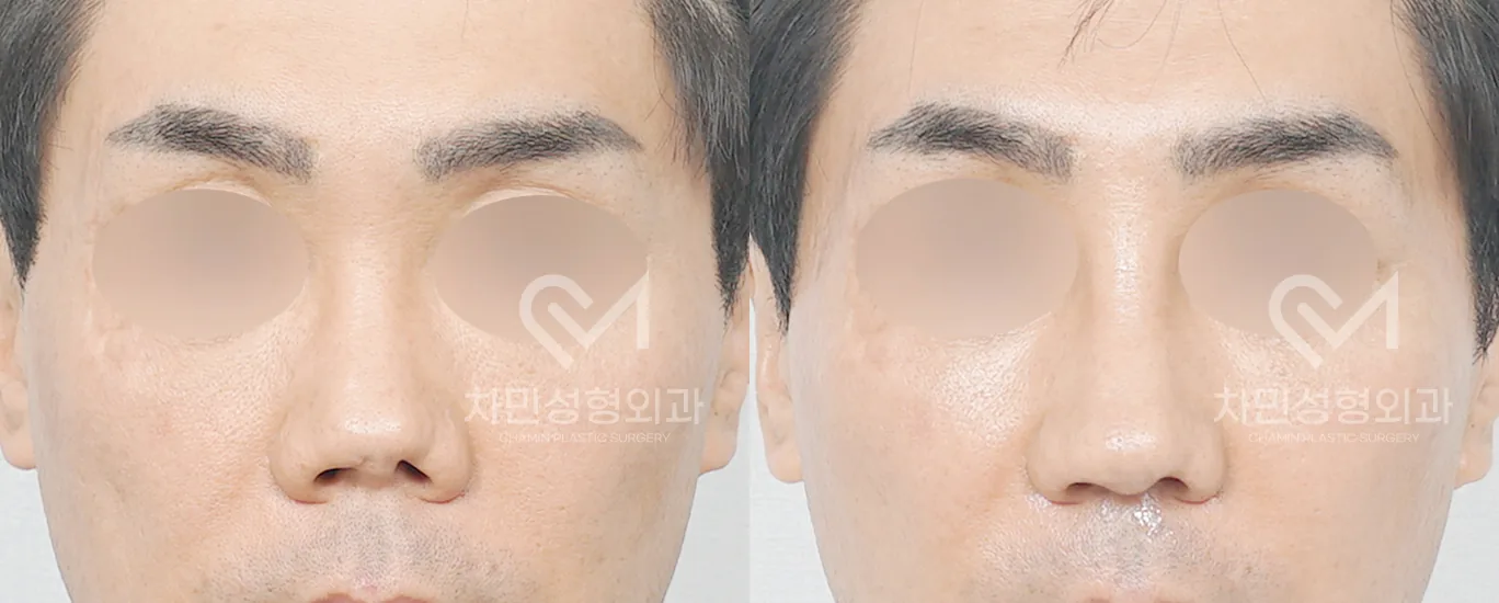 Chamin整形外科挛缩鼻修复术前术后正面对比案例8