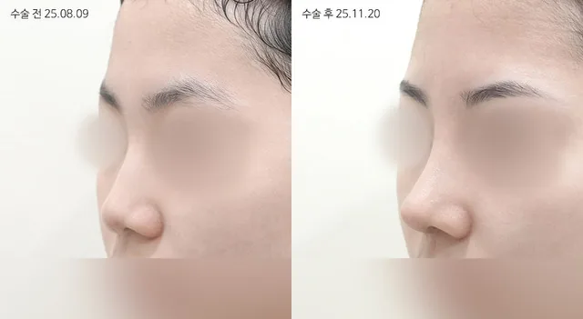 공식 전후 사례 6