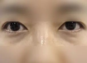眼下填充术前案例二