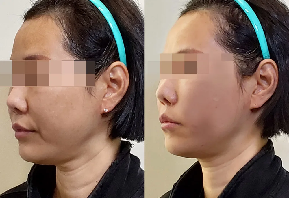 鼻唇沟埋线提升术前术后