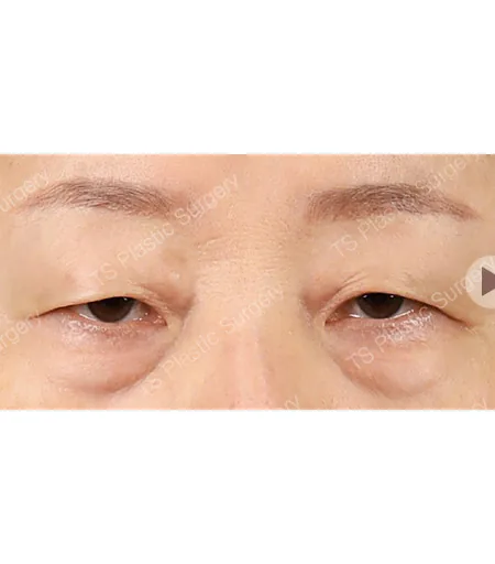 综合眼部整形术前