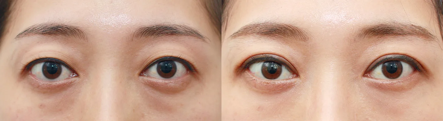 Official before-and-after cases 4