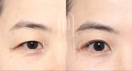 Luho眼部修复术后2个月案例