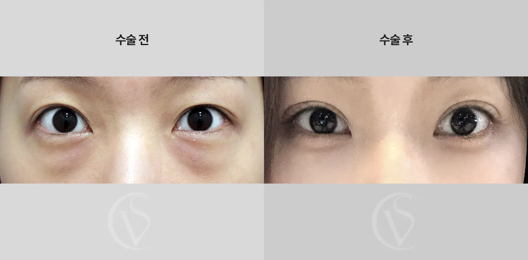 공식 전후 사례 10