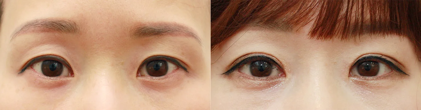 Official before-and-after cases 3