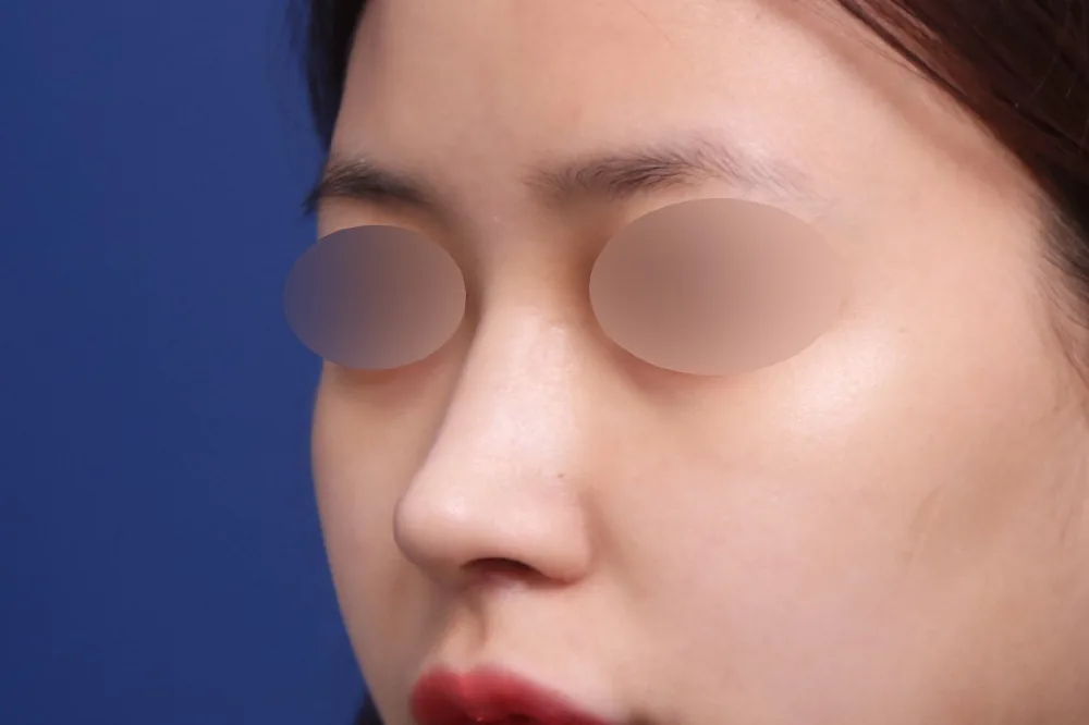 鼻整形与鼻翼缩小术后