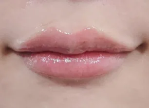 唇部填充术后案例四