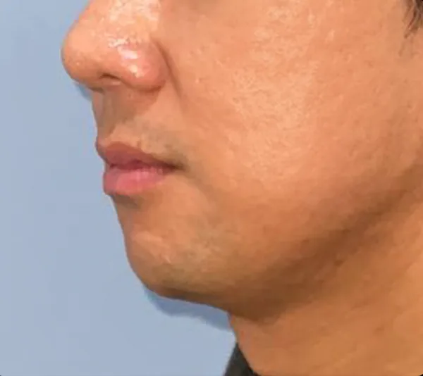 公式症例 3