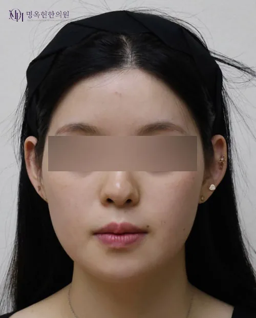 法令纹与前颧部埋线提升术前