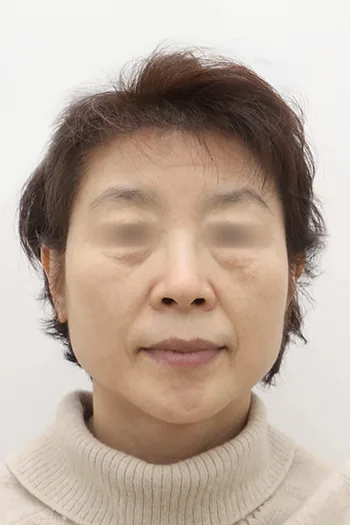 Note整形外科上下睑眉提升术前