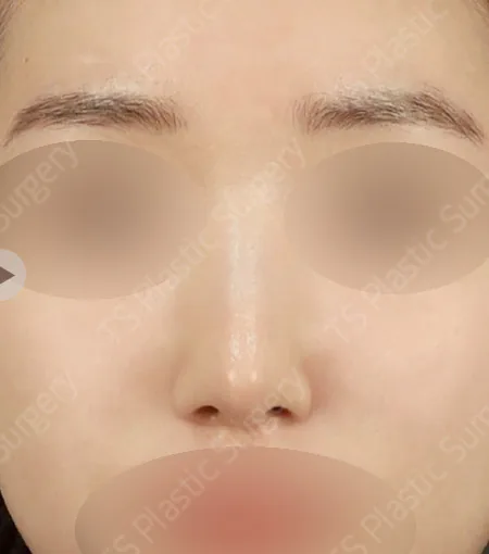 综合鼻整形术后