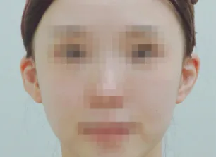 耳部填充术后
