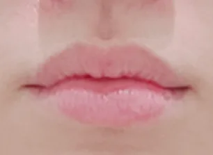 唇部填充术前案例一
