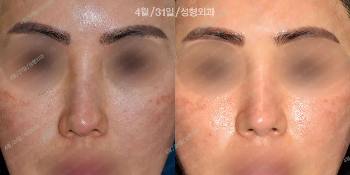April 31美容外科 症例写真 3