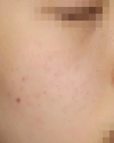 公式症例 20