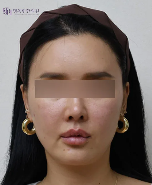 面部轮廓线与木偶纹埋线提升术前