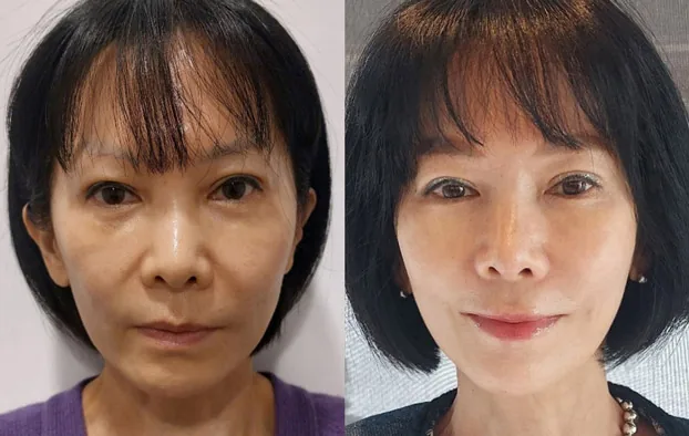 眼下与中面部埋线提升术前术后