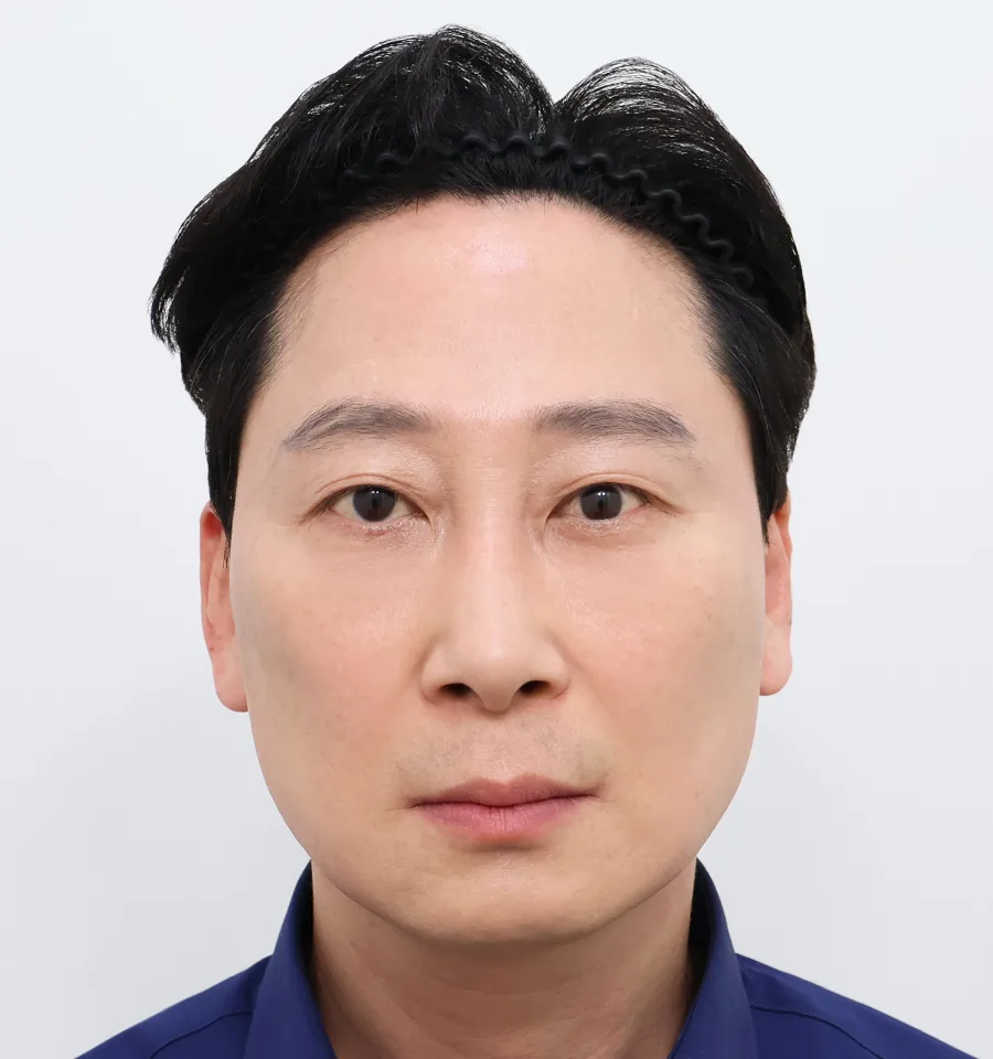 普爱德迷你面部提升术后6个月正面照片