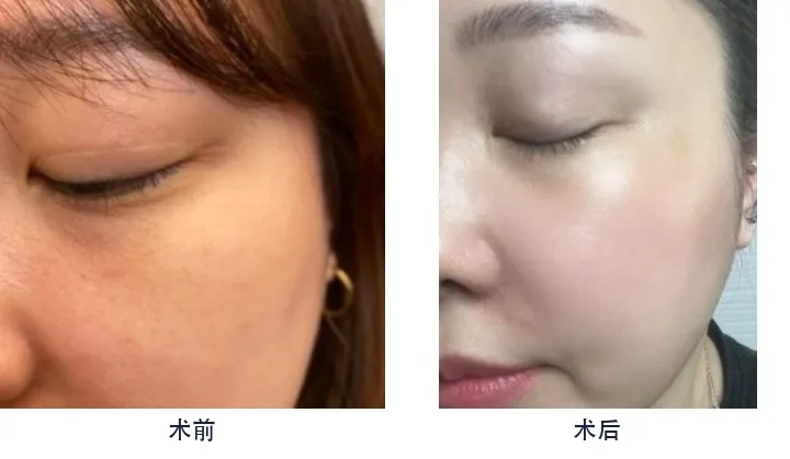 Official before-and-after cases 4