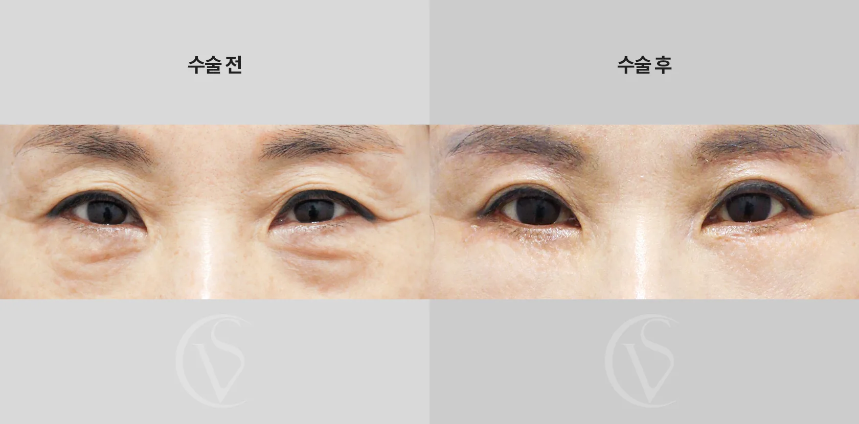공식 전후 사례 11