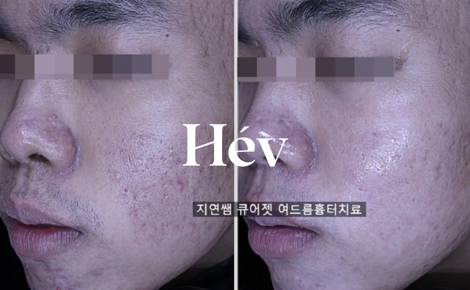 痘坑痘疤综合治疗术前术后对照
