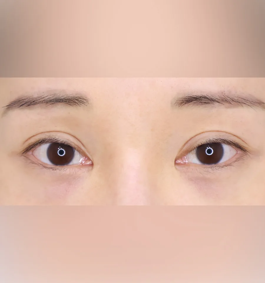普爱德眼部修复术前局部照片