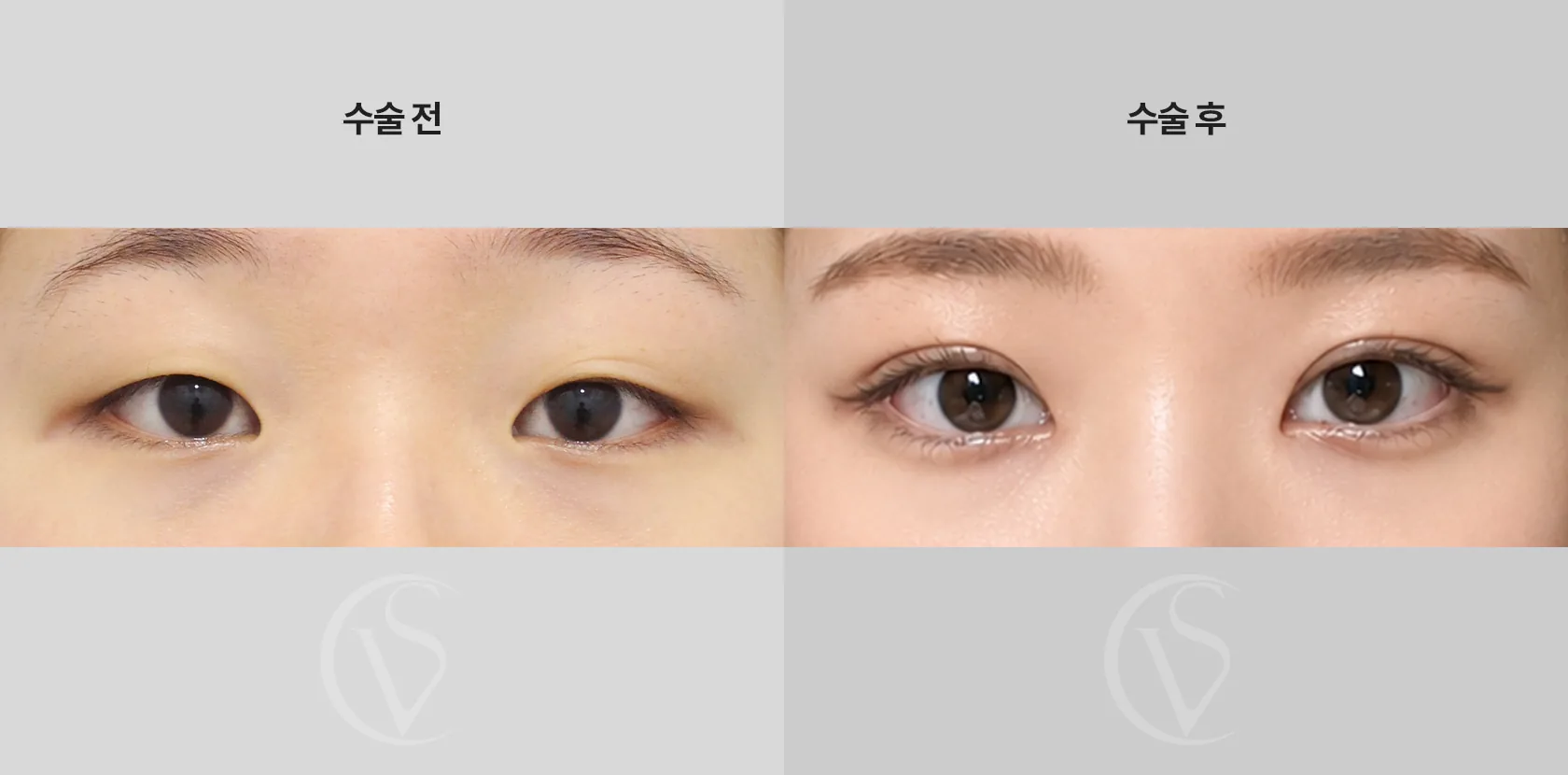 공식 전후 사례 7
