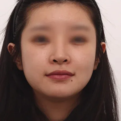 BOMON卧蚕填充术后