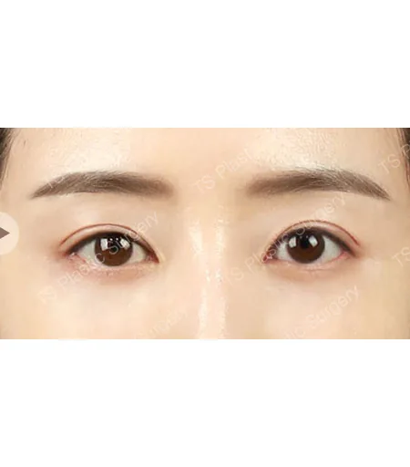 不对称眼型综合矫正术后