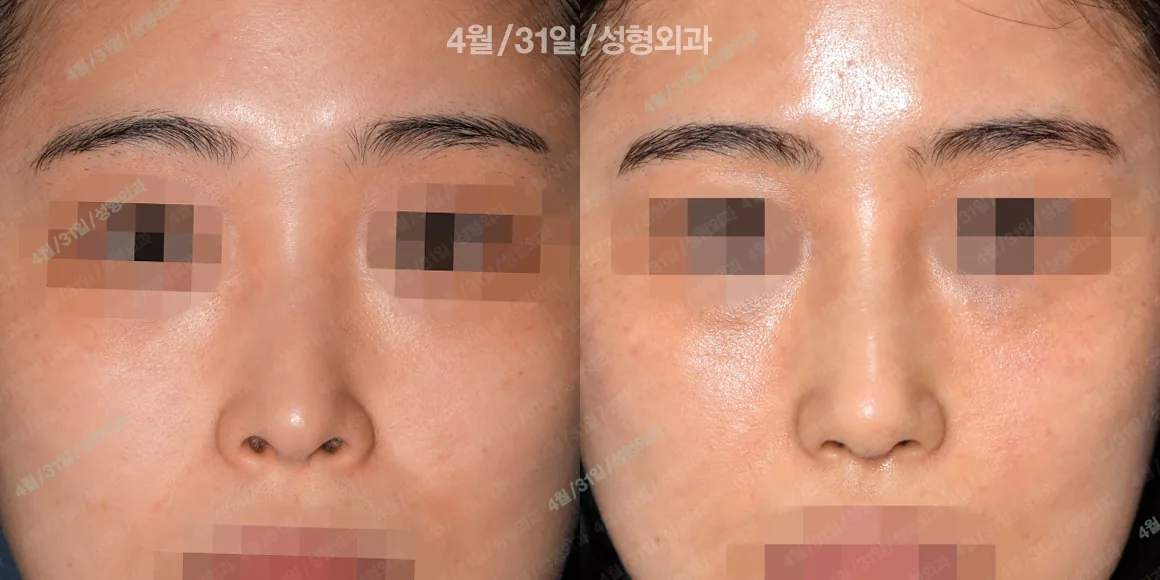 April 31美容外科 症例写真 7