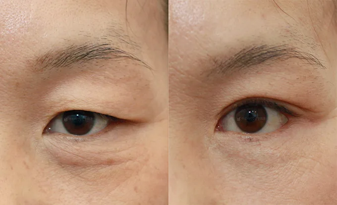 Official before-and-after cases 7