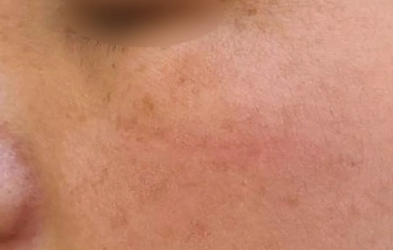 面部瘢痕切除术后
