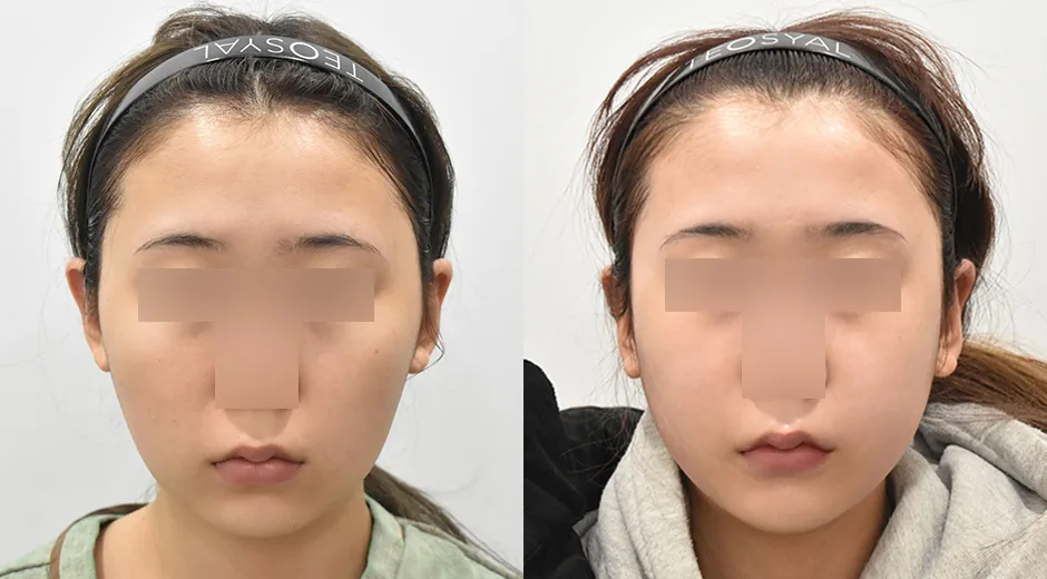 下巴前移与颧骨缩小术前术后对照