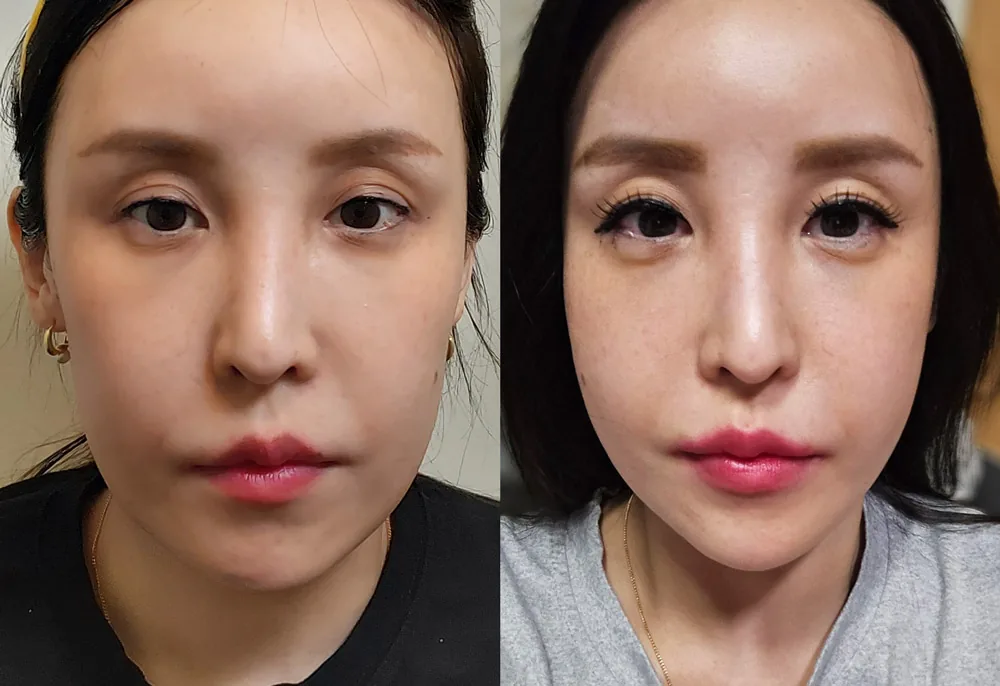 迷你埋线提升术前术后