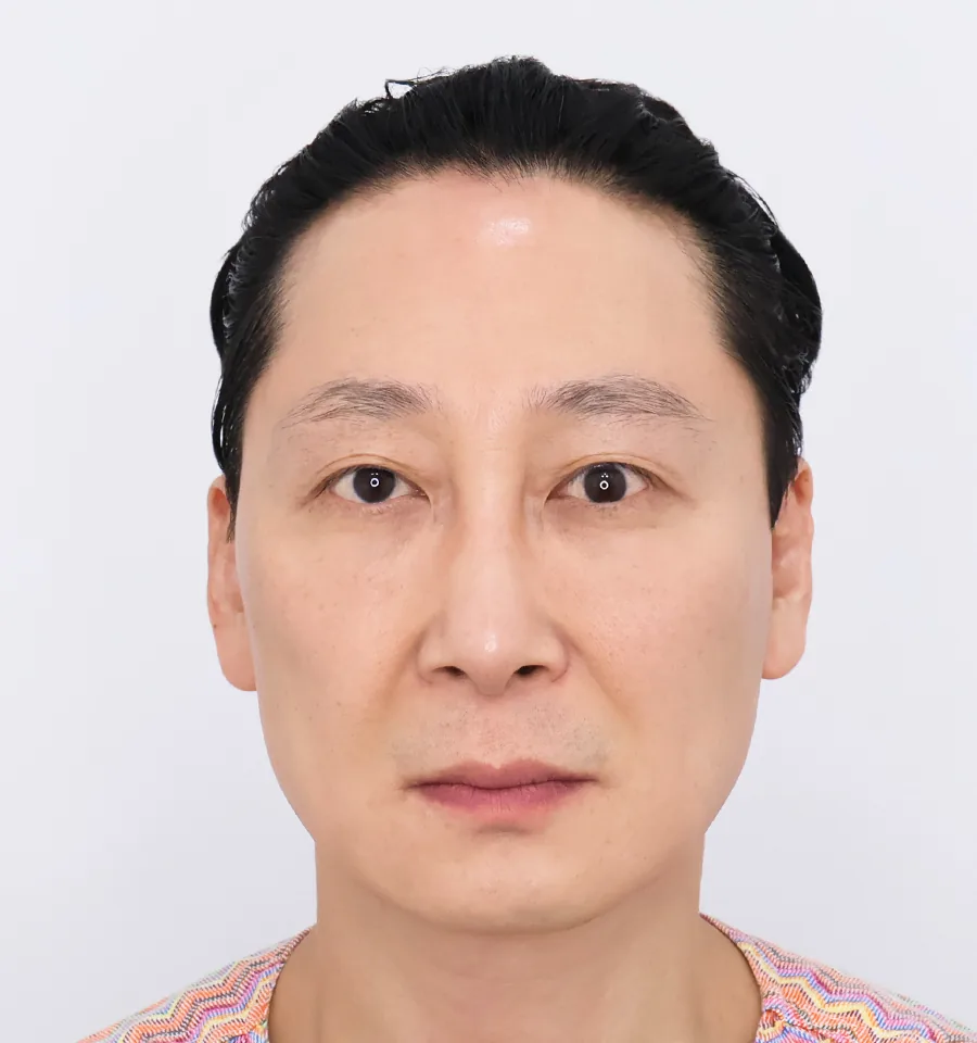普爱德迷你面部提升术前正面照片