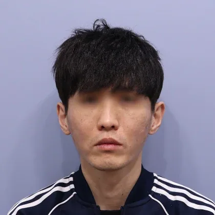 BOMON面颊填充术后