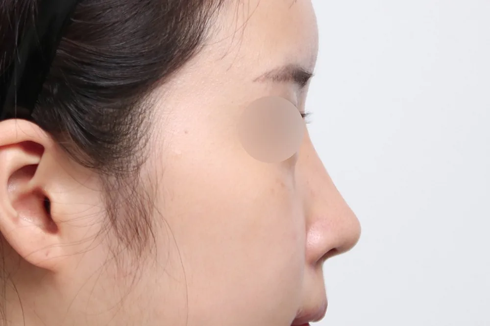 鼻综合整形术后3个月
