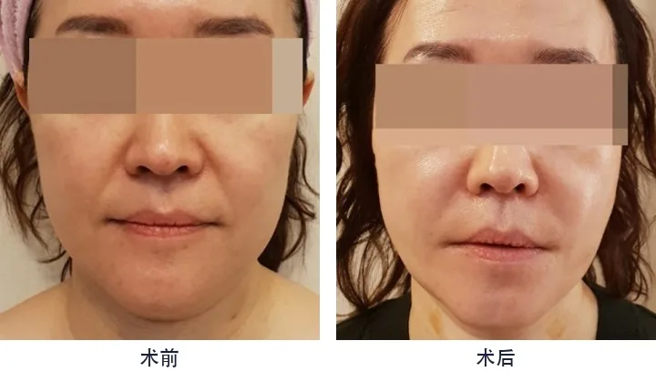 Official before-and-after cases 11