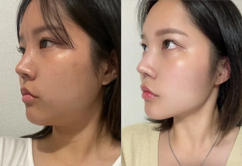 下颌线与双下巴埋线提升术前术后案例二