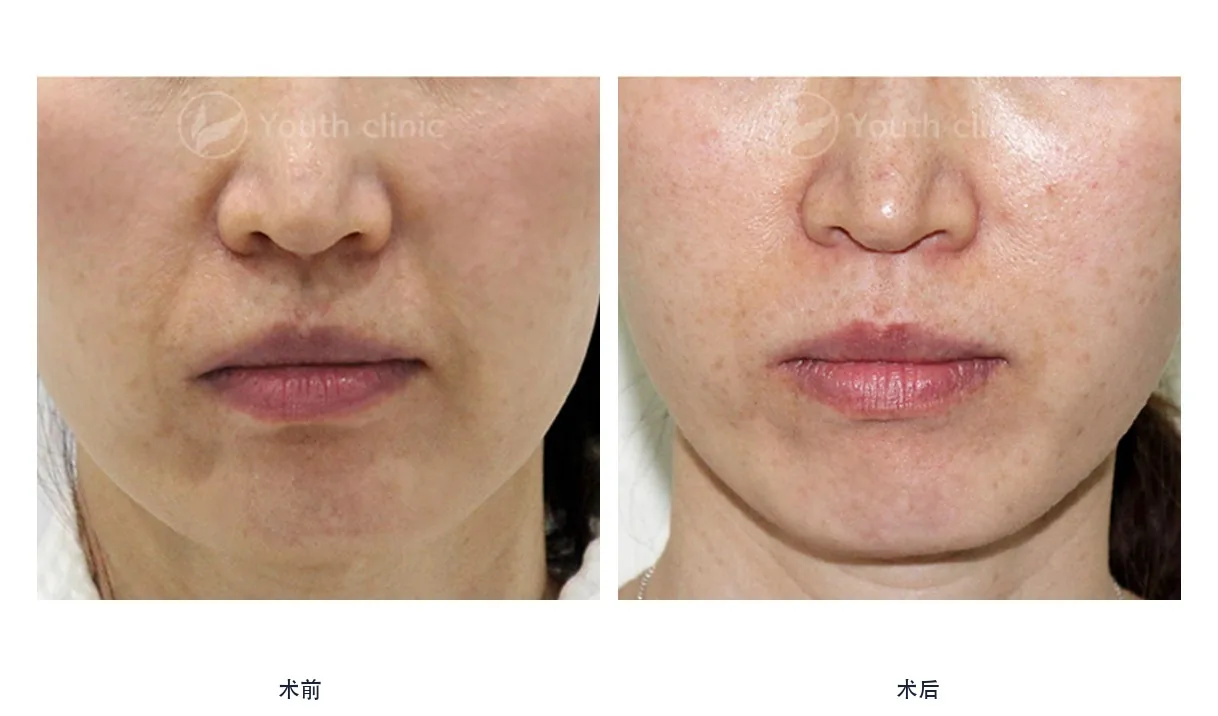 Official before-and-after cases 16