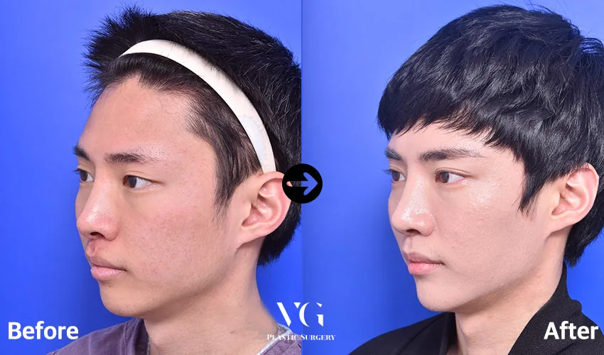 Very Good Plastic Surgery Before-and-after cases 8