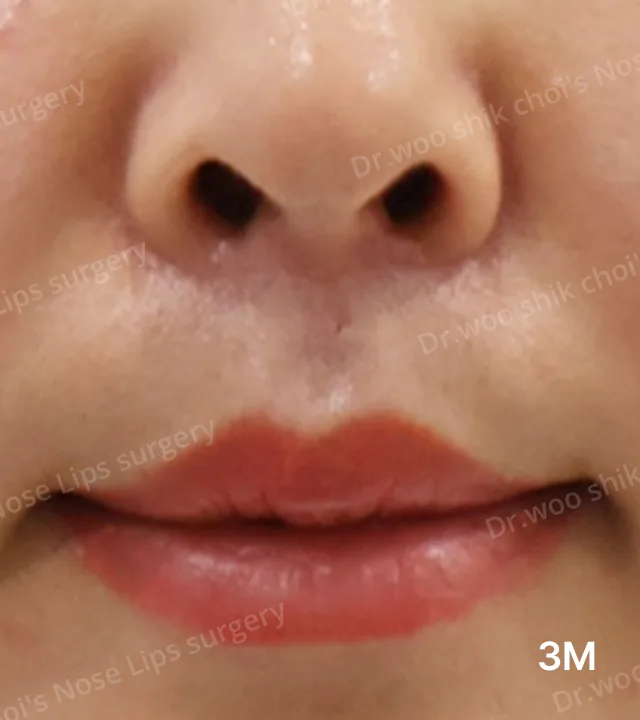 人中疤痕修复术后3个月