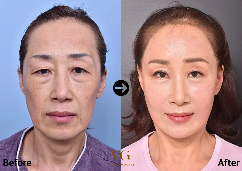 Very Good Plastic Surgery Before-and-after cases 24