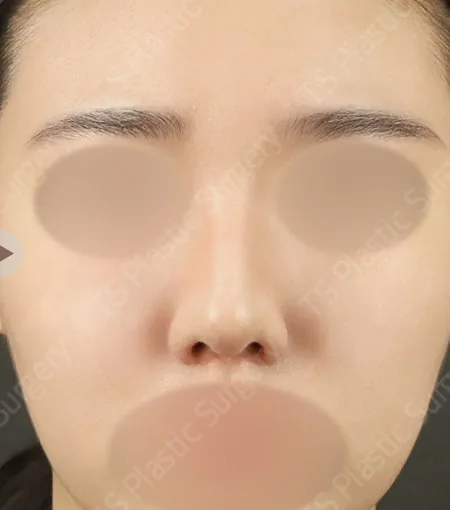 鼻梁鼻尖蒜头鼻矫正术后