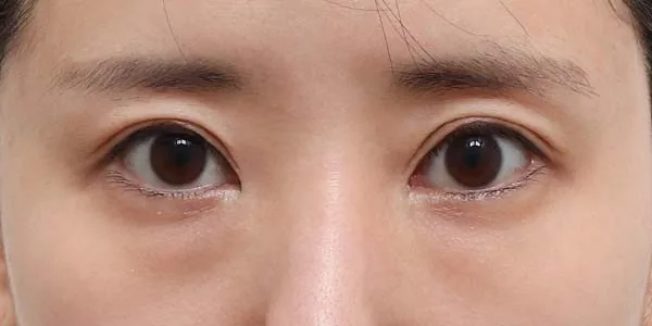 Must眼下脂肪重排术前案例一