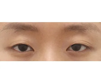 Note整形外科自然粘连开内眼角术前案例