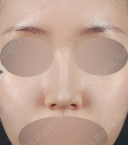 鼻梁鼻尖驼峰鼻矫正术后